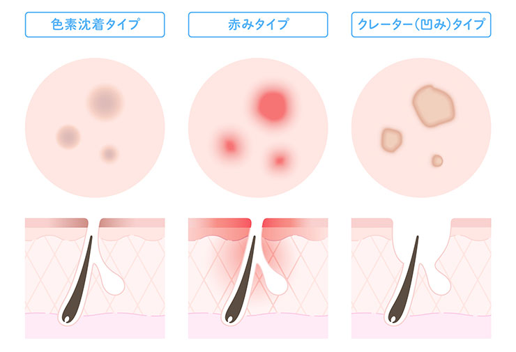 ニキビ跡の種類